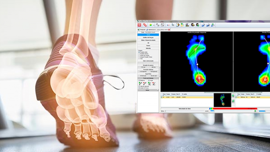 Baropodometria Computadorizada